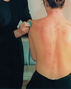 guasha Fire Cupping and Back Scraping Could Save Your Life!